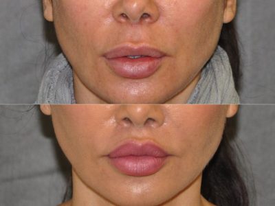 Modified Upper Lip Lift to Correct Over-Filling - Front