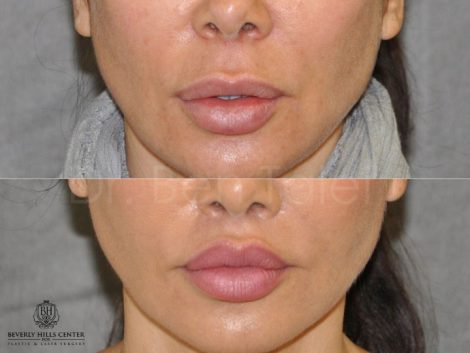 Modified Upper Lip Lift to Correct Over-Filling - Front