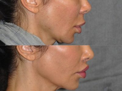 Modified Upper Lip Lift to Correct Over-Filling - Right Side