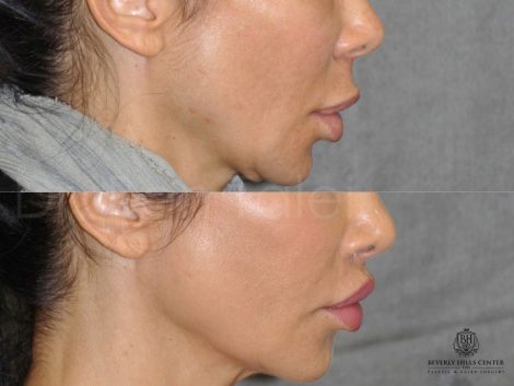 Modified Upper Lip Lift to Correct Over-Filling - Right Side