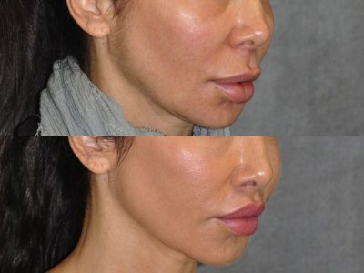 Modified Upper Lip Lift to Correct Over-Filling - Right Side