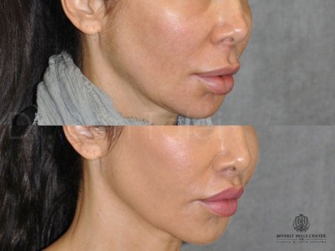 Modified Upper Lip Lift to Correct Over-Filling - Right Side