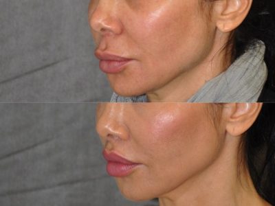 Modified Upper Lip Lift to Correct Over-Filling - Left Side