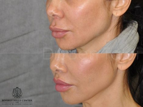 Modified Upper Lip Lift to Correct Over-Filling - Left Side