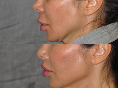 Modified Upper Lip Lift to Correct Over-Filling - Left Side