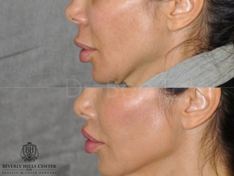Modified Upper Lip Lift to Correct Over-Filling - Left Side