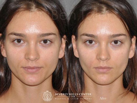Beverly Hills Center Female Patient Before and After Non-surgical Cheek Procedure