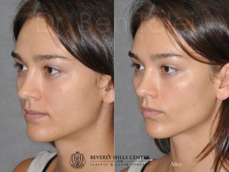 Beverly Hills Center Female Patient Before and After Non-surgical Cheek Procedure