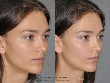 Beverly Hills Center Female Patient Before and After Non-surgical Cheek Procedure
