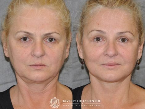 AuraLyft, BrowLift, Eyelid Rejuvenation, Lip Augmenation – Front