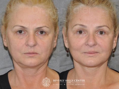 AuraLyft, BrowLift, Eyelid Rejuvenation, Lip Augmenation - Front