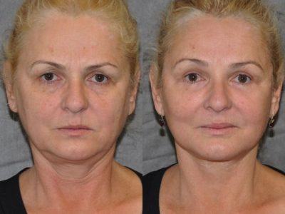 AuraLyft, BrowLift, Eyelid Rejuvenation, Lip Augmenation - Front