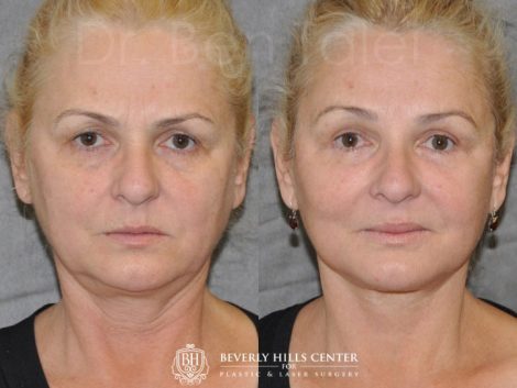 AuraLyft, BrowLift, Eyelid Rejuvenation, Lip Augmenation - Front
