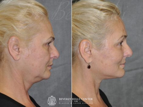 AuraLyft, BrowLift, Eyelid Rejuvenation, Lip Augmenation – Right Side
