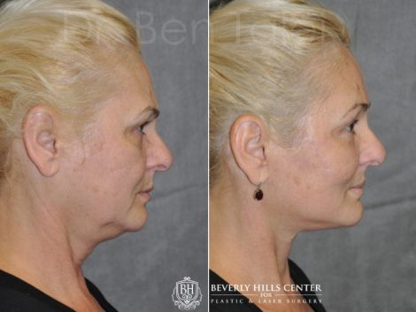 AuraLyft, BrowLift, Eyelid Rejuvenation, Lip Augmenation - Right Side