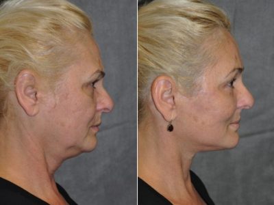 AuraLyft, BrowLift, Eyelid Rejuvenation, Lip Augmenation - Right Side