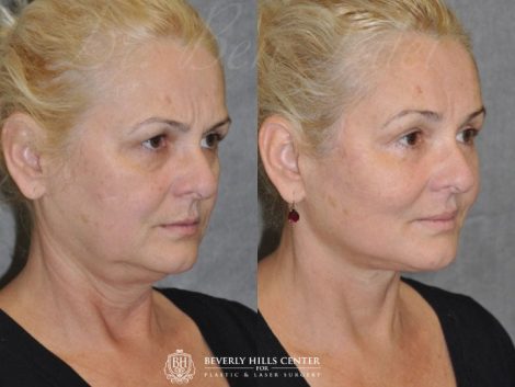 AuraLyft, BrowLift, Eyelid Rejuvenation, Lip Augmenation – Right Side