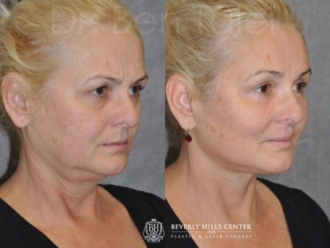 AuraLyft, BrowLift, Eyelid Rejuvenation, Lip Augmenation - Right Side