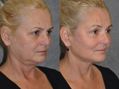 AuraLyft, BrowLift, Eyelid Rejuvenation, Lip Augmenation - Right Side