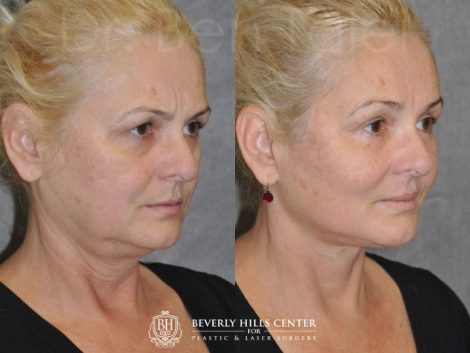 AuraLyft, BrowLift, Eyelid Rejuvenation, Lip Augmenation - Right Side