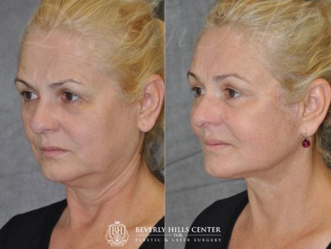 AuraLyft, BrowLift, Eyelid Rejuvenation, Lip Augmenation – Left Side