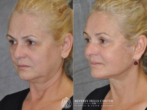AuraLyft, BrowLift, Eyelid Rejuvenation, Lip Augmenation - Left Side