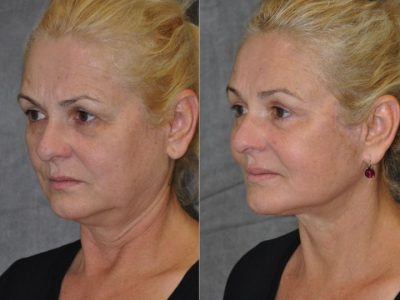 AuraLyft, BrowLift, Eyelid Rejuvenation, Lip Augmenation - Left Side