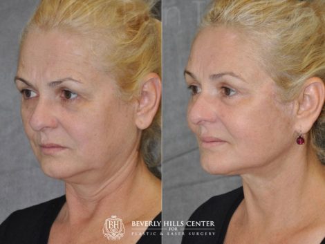 AuraLyft, BrowLift, Eyelid Rejuvenation, Lip Augmenation - Left Side