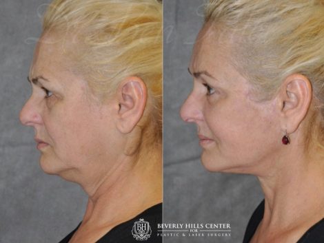AuraLyft, BrowLift, Eyelid Rejuvenation, Lip Augmenation – Left Side