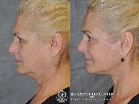 AuraLyft, BrowLift, Eyelid Rejuvenation, Lip Augmenation - Left Side