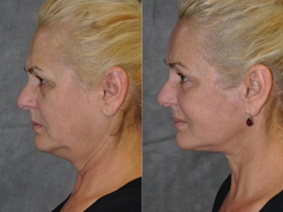 AuraLyft, BrowLift, Eyelid Rejuvenation, Lip Augmenation - Left Side
