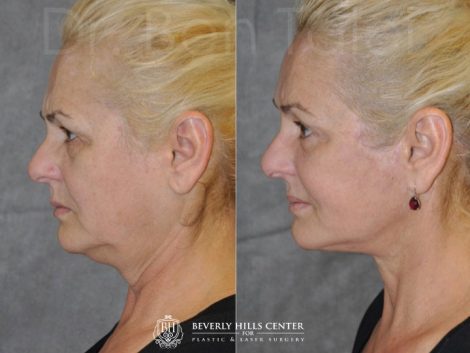 AuraLyft, BrowLift, Eyelid Rejuvenation, Lip Augmenation - Left Side