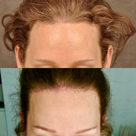 Beverly Hills Center female patient before and after hairline lowering