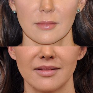 Modified upper lip lift - Front