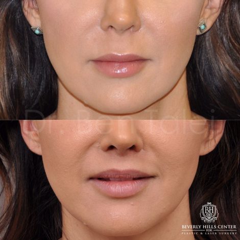 Modified upper lip lift - Front
