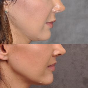 Modified upper lip lift - Right Side