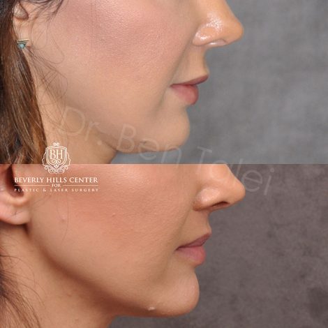 Modified upper lip lift - Right Side