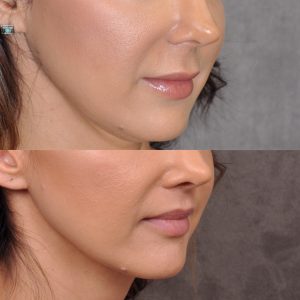Modified upper lip lift - Right Side