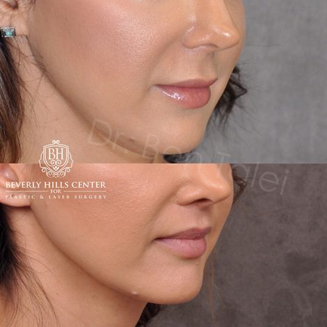 Modified upper lip lift - Right Side