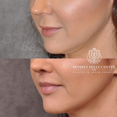 Modified upper lip lift - Left Side
