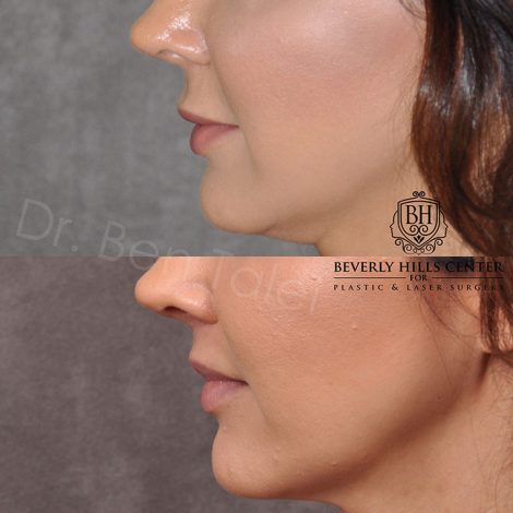 Modified upper lip lift - Left Side