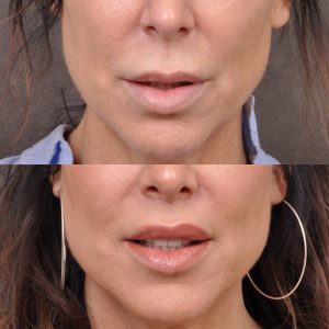 Modified Upper Lip Lift - Front