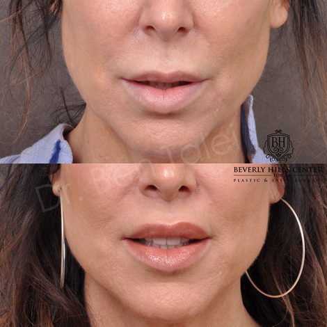 Modified Upper Lip Lift - Front