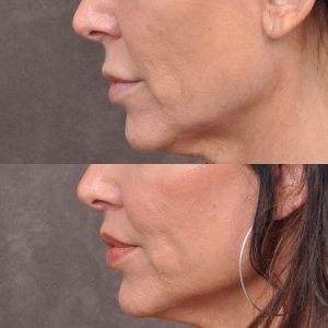 Modified Upper Lip Lift - Left Side