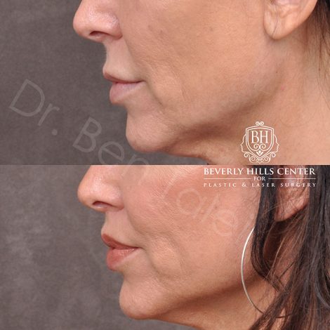 Modified Upper Lip Lift - Left Side