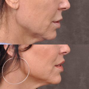 Modified Upper Lip Lift - Right Side