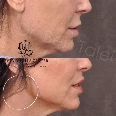 Modified Upper Lip Lift - Right Side