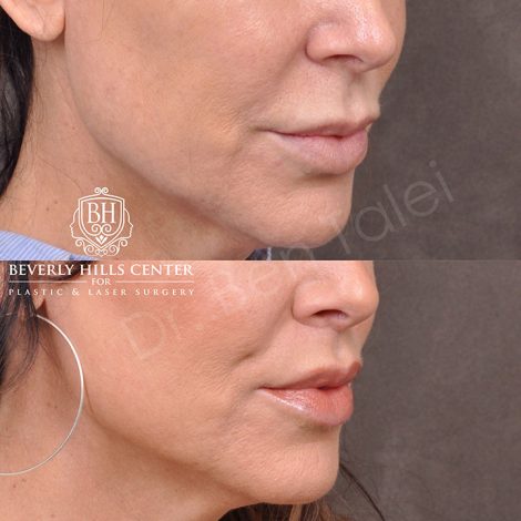 Modified Upper Lip Lift - Right Side