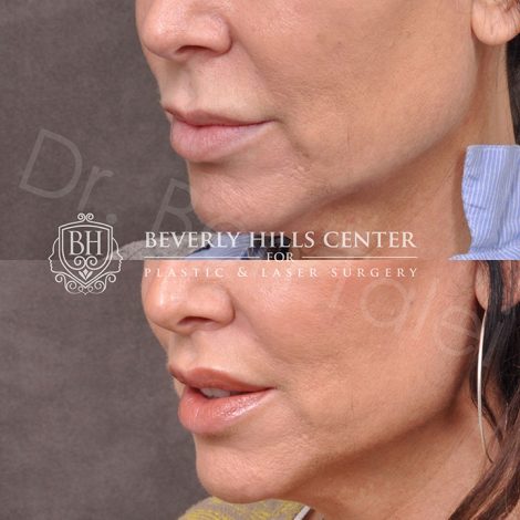 Modified Upper Lip Lift - Left Side