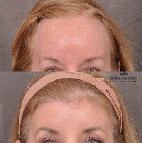 ForeheadPlasty / Hairline Lowering - Front